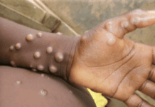 Nigeria confirms 39 mpox cases