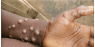 Nigeria confirms 39 mpox cases