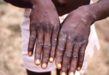 Akwa Ibom records five Mpox cases