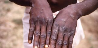 Akwa Ibom records five Mpox cases