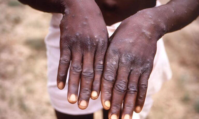 Akwa Ibom, Enugu highest, as Nigeria confirms 67 cases of Mpox in 23 states, FCT