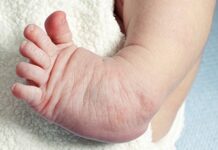 Clubfoot: With treatment, 95% can walk, run, and move for life